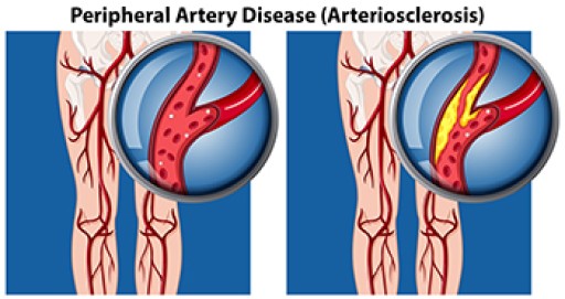 Peripheral Artery Disease and Your Feet