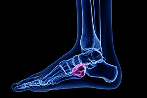 The Ankle Ailment Known as Cuboid Syndrome